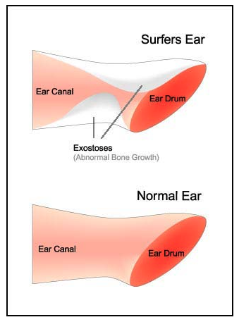 Illustration diagram of Surfer's Ear